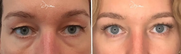 Blépharoplastie 4 paupières