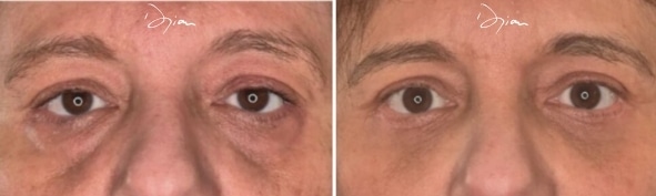 Blépharoplastie combinée