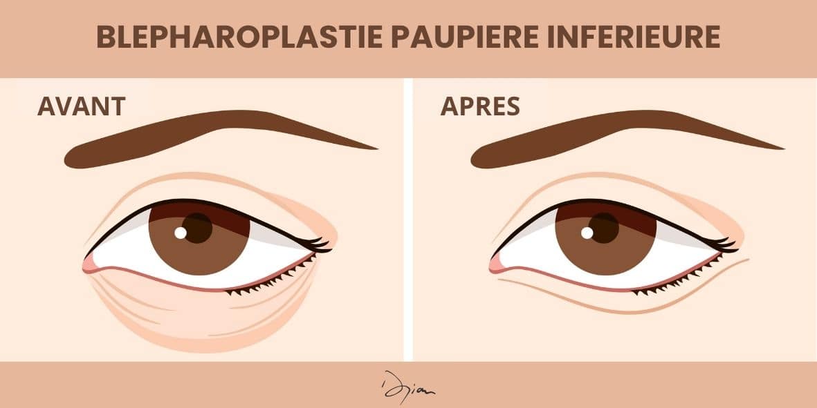 Blépharoplastie paupière infèrieure infographie avant après