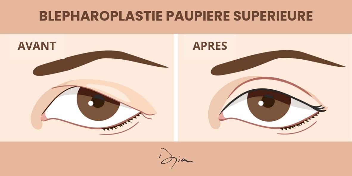 Blépharoplastie paupière supérieure infographie avant après