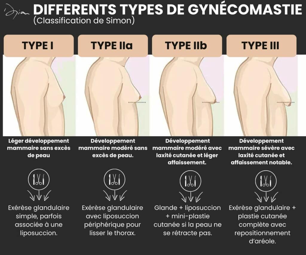 Différents types de gynécomastie