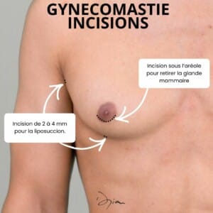 INCISIONS GYNECOMASTIE