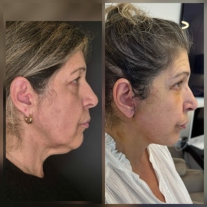 avant apres lifting cervicofacial