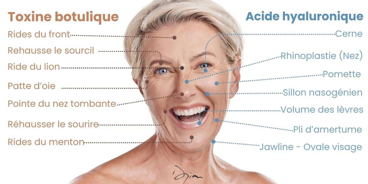 Toxine botulique vs Acide Hyaluronique Zones de traitement