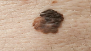 melanome carcinome peau