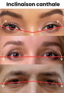 Inclinaison canthale