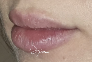 russian lips injection