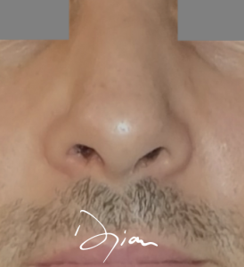 rhinoplastie pointe du nez 