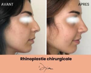 Rhinoplastie chirurgicale femme 1