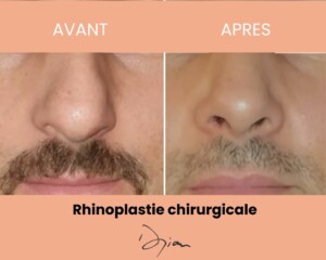 Rhinoplastie chirurgicale homme