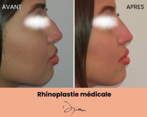 Rhinoplastie médicale femme