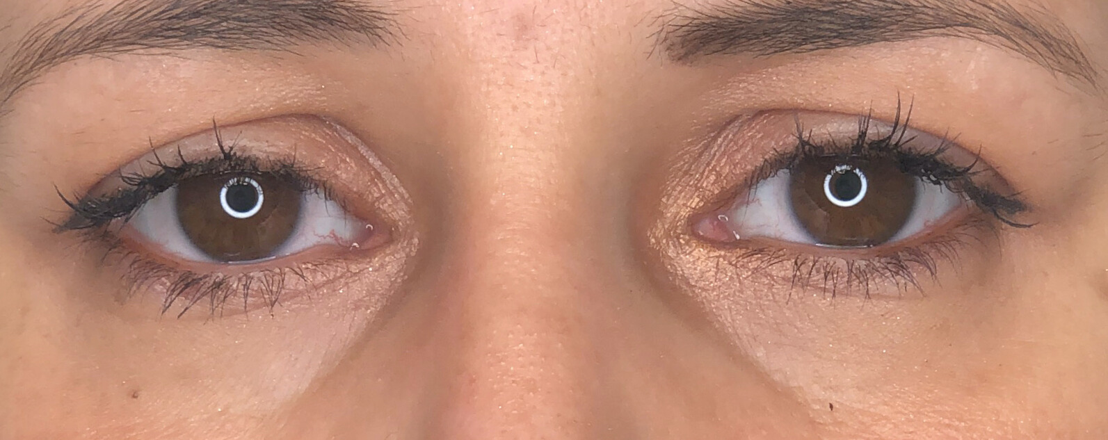 dark circles hyaluronic acid injection
