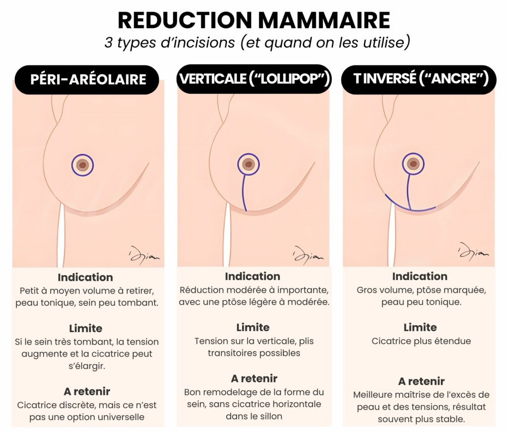 réduction mammaire 3 types de cicatrices