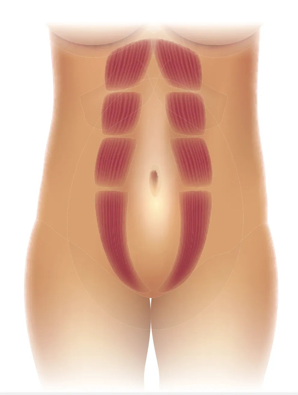 Diastasis et abdominoplastie : chirurgie réparatrice ventre