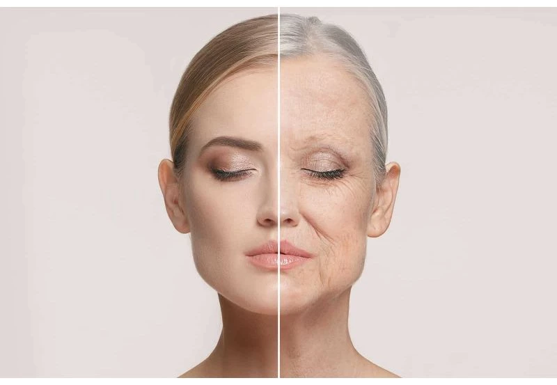 Deep Plane Facelift : lifting cervicofacial à Paris