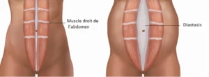 diastasis grossesse