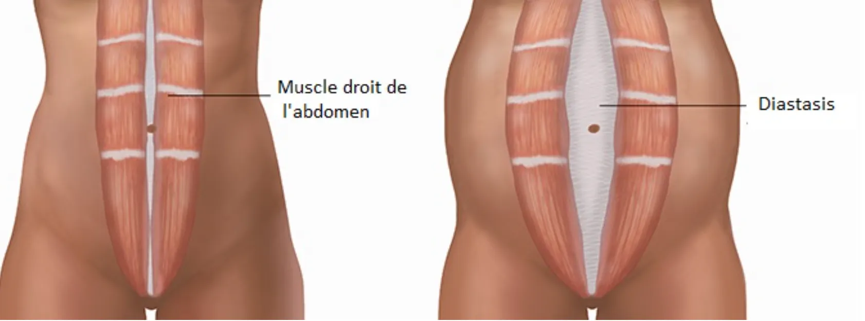 diastasis grossesse