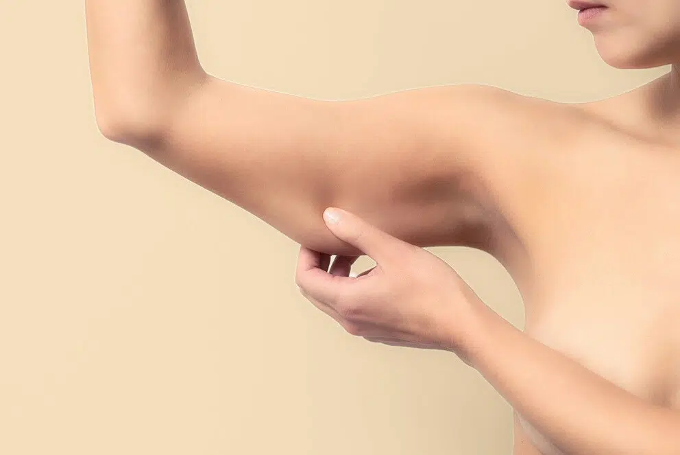 Voir Lifting des bras ou brachioplastie
