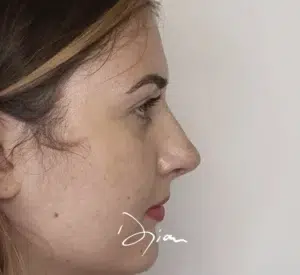 rhinoplastie apres intervention