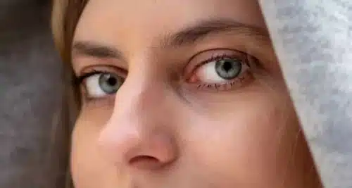 Voir Comment enlever une bosse sur le nez ?