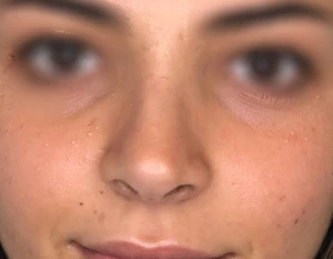 photos apres rhinoplastie de pointe