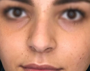 photo avant rhinoplastie de pointe
