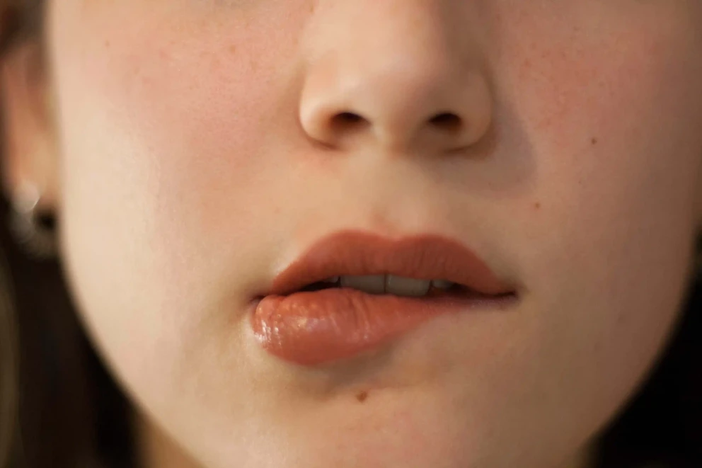 Voir LIP LIFT à PARIS - LIFTING LÈVRE SUPÉRIEURE