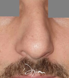 rhinoplastie pointe nez