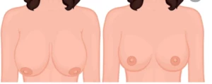 lifting des seins