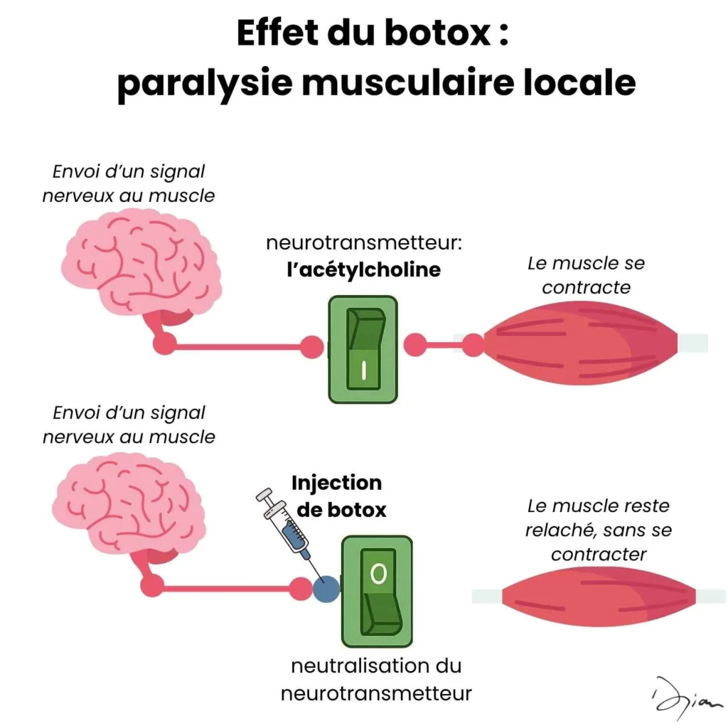 infographie effet du Botox sur le muscle
