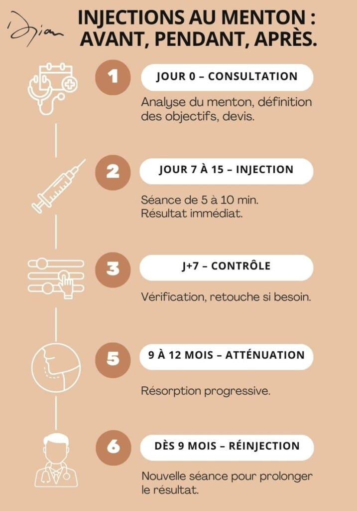 Déroulement des injections d'Acide hyaluronique au niveau du menton