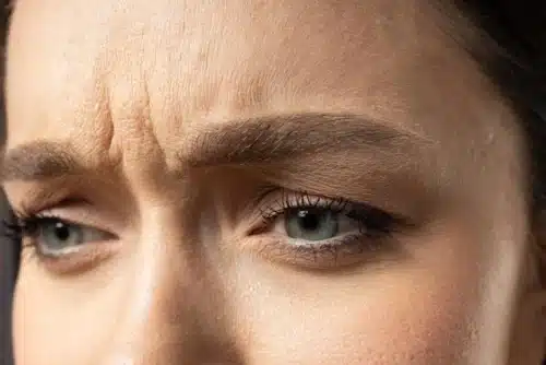 Voir Botox ride du lion : fini l’air fatigué et stressé