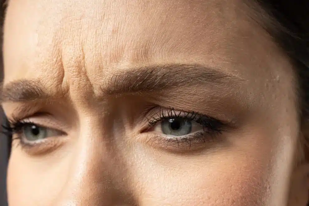 Botox ride du lion : fini l’air fatigué et stressé