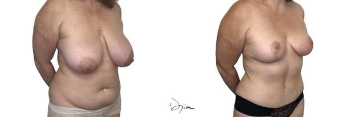 avant après réduction mammaire profil