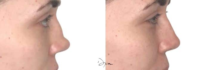 avant après Rhinoplastie médicale