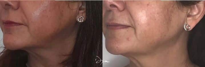 Avant après traitement de la Jawline