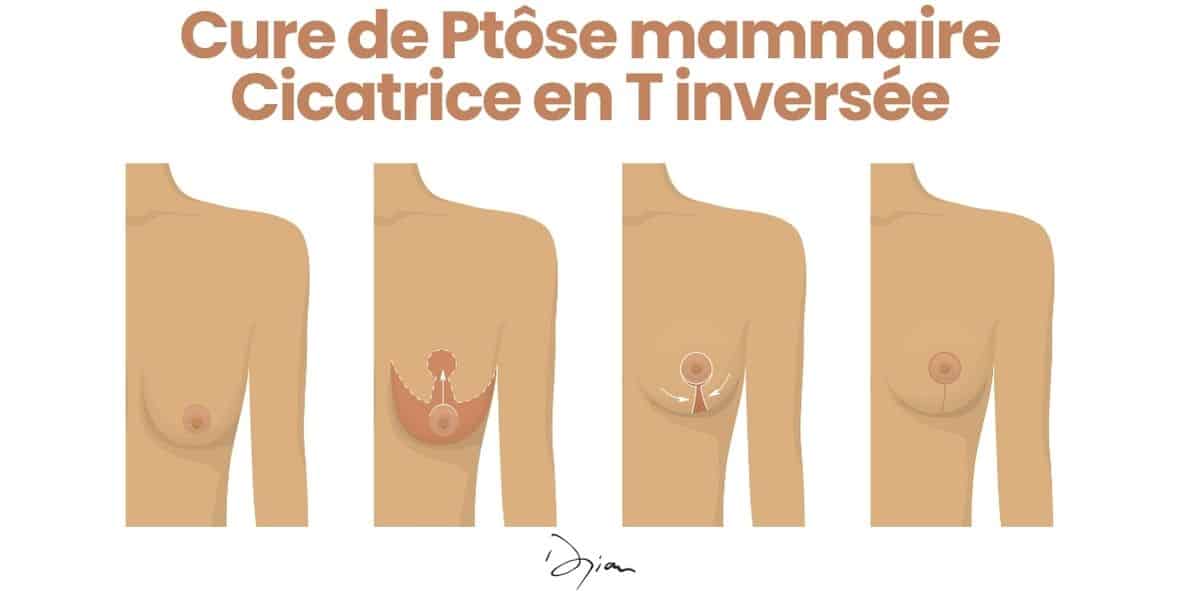 cicatrice ptose mammaire