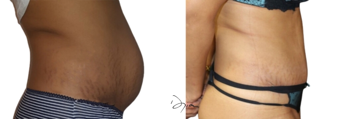 diastasis treatment before after