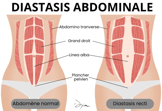 abdominal diastasis Anatomy