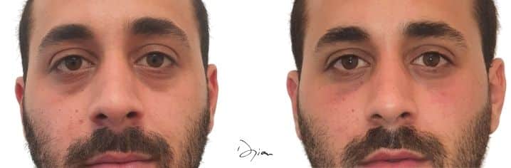 injection d'acide hyaluronique pour cernes