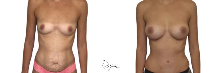 mommy makeover and diastasis before and after
