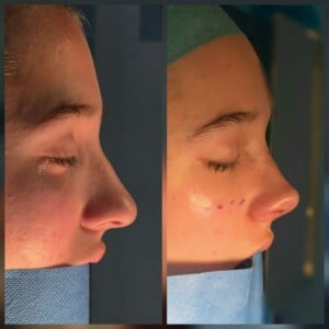 Avant après une rhinoplastie au bloc opératoire