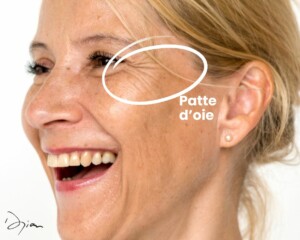 Femme souriant de profil faisant apparaitre les rides patte d'oie au coin de l'oeil.