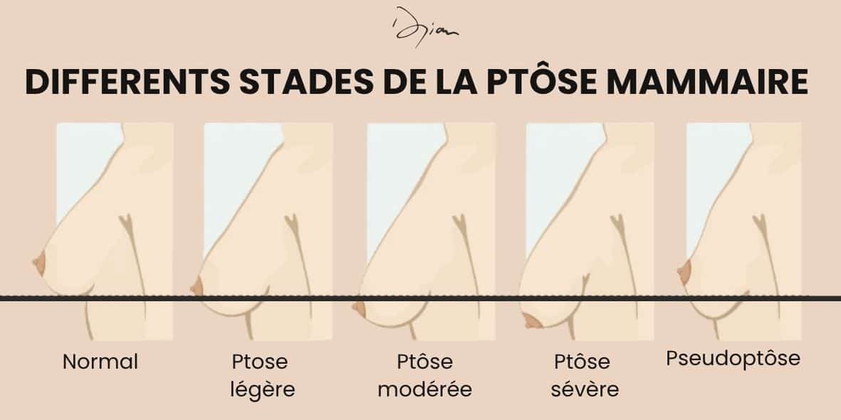 stades de la ptôse mammaire