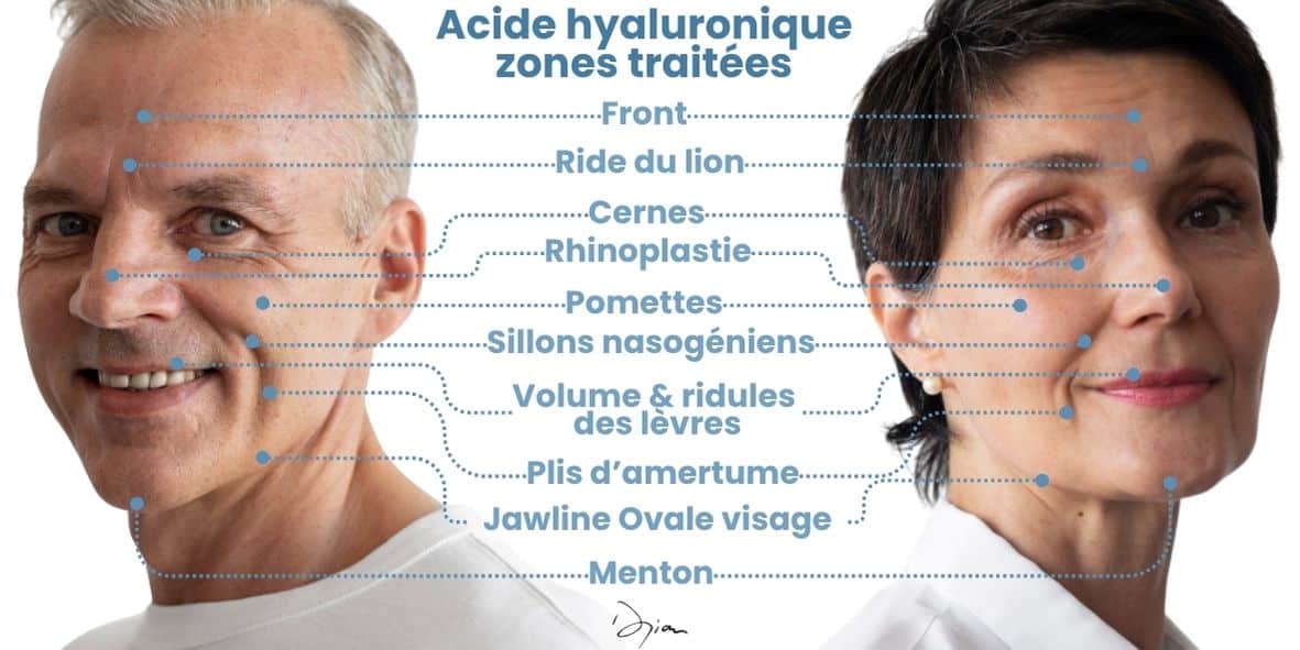 Zones du visages traitées par l'acide hyaluronique