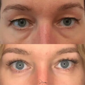 Avant après Blépharoplastie complète