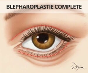 Blépharoplastie complète