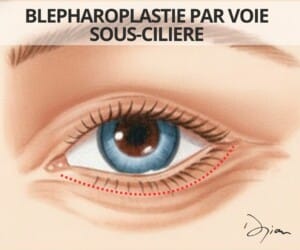 Blépharoplastie inférieure par voie sous cilière