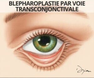Blépharoplastie inférieure par voie transconjonctivale