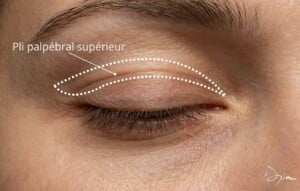Incision blépharoplastie supérieure
